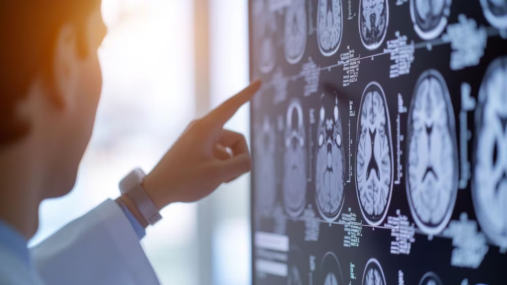 alzheimer esclerosis