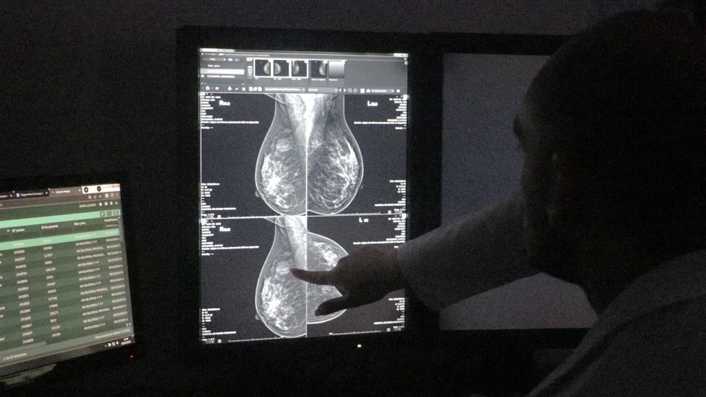 MAMOGRAFIA